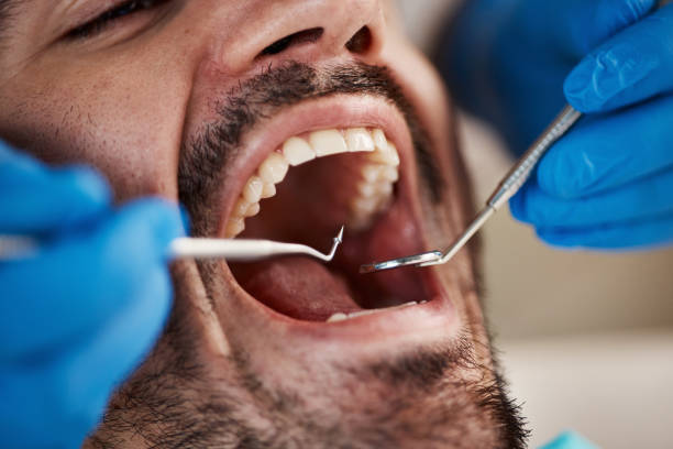 Best Emergency Wisdom Teeth Removal in Port Byron, IL